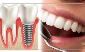 چجوری به صورت آنلاین نوبت دندانپزشکی برای ایمپلنت دندان در شیراز بگیریم
