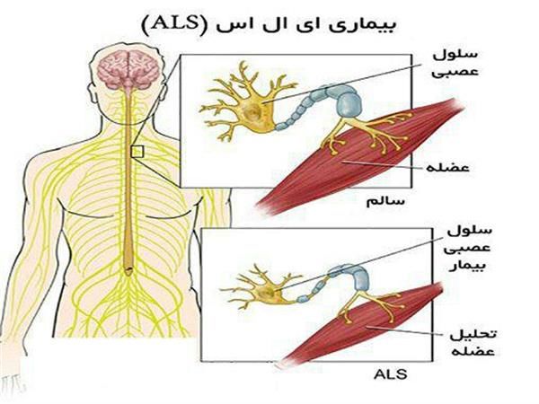 بیماری ای ال اس (ALS) چیست و چه علائمی دارد؟