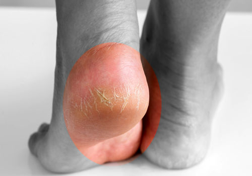 پاشنه پای ترک خورده؛ آیا کمبود ویتامین C دلیل آن است؟