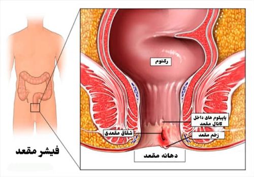 شقاق چیست؟ (فیشر) یا زخم مقعدی؛ علت، علائم، تشخیص و معاینه